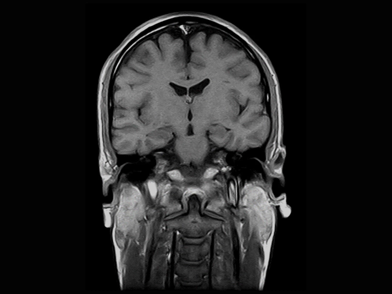 Magnifico™Open - Brain SE T1 coronal