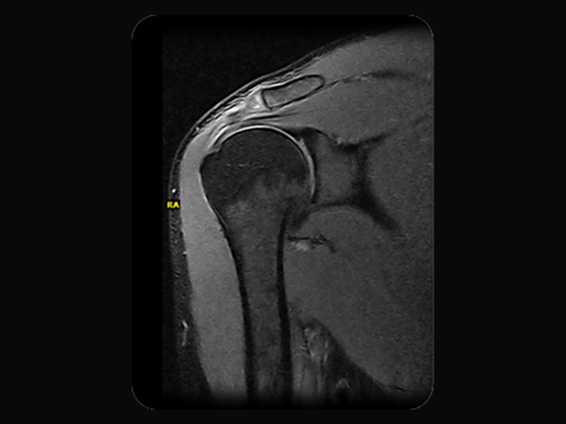 Magnifico™Open - Shoulder SPED coronal