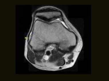 S-scan - Knee FSE T2 Axial
