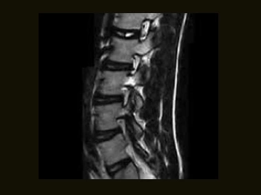 S-scan - L Spine FSE T2 Sagittal